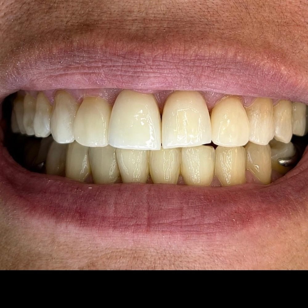 Facetas em resina - depois
