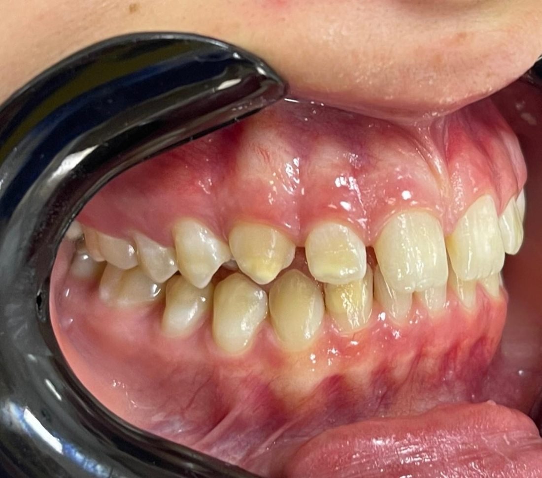 Antes Invisalign