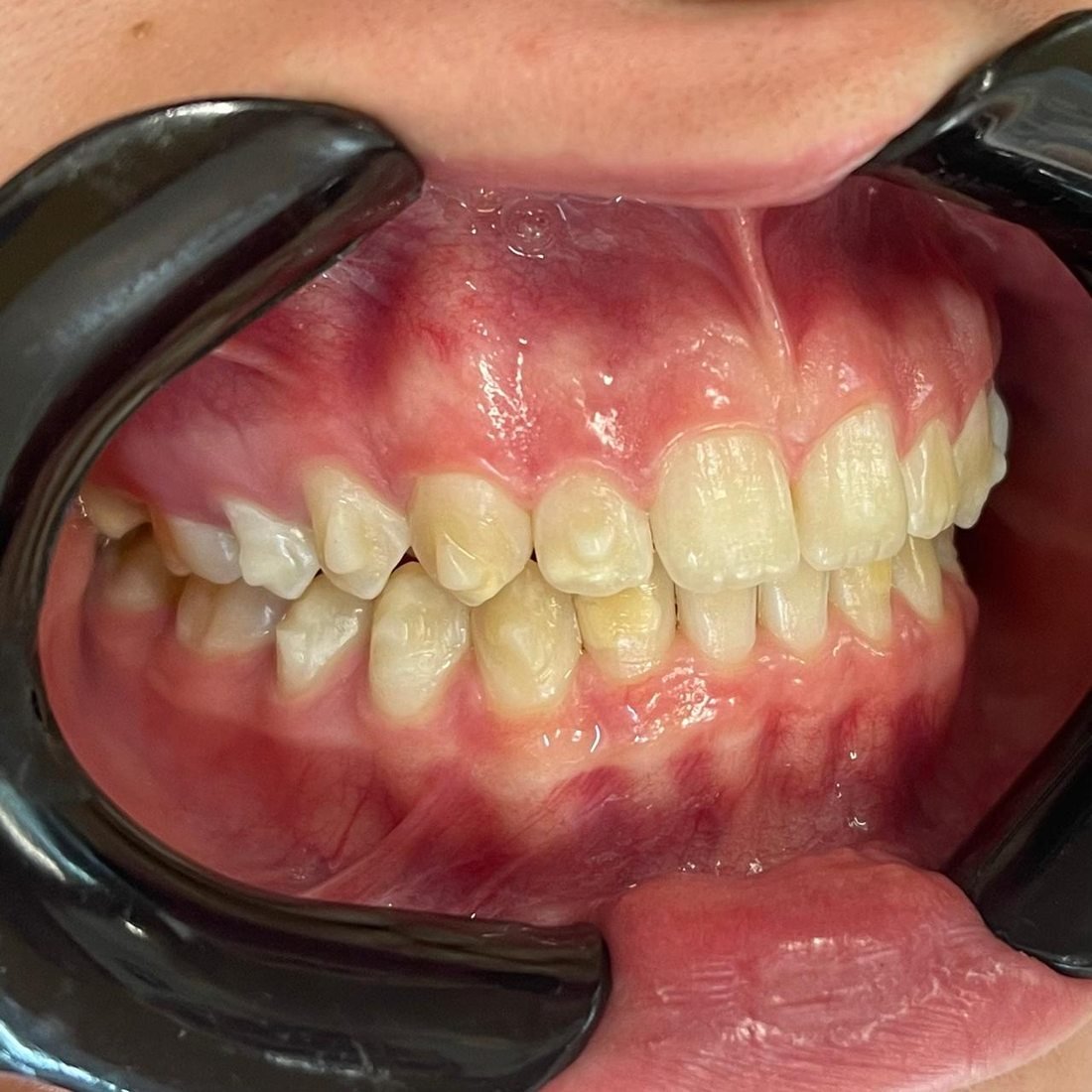 Depois Invisalign